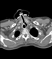 T-e Fistulae With Stent in Trachea and Esophagus- See Full Sequence - CTisus CT Scan