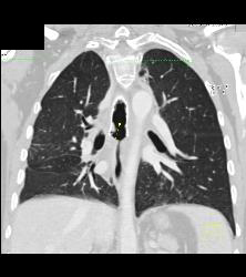 T-e Fistulae With Stent in Trachea and Esophagus- See Full Sequence - CTisus CT Scan