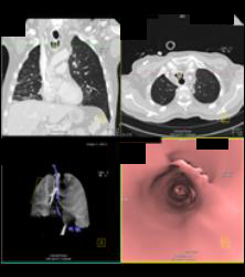 T-e Fistulae With Stent in Trachea and Esophagus- See Full Sequence - CTisus CT Scan