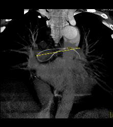 Broken Catheter Found in Pulmonary Artery- Unsuspected Finding - CTisus CT Scan