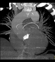 Broken Catheter Found in Pulmonary Artery- Unsuspected Finding - CTisus CT Scan