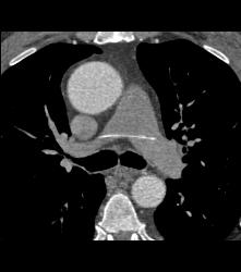 Broken Catheter Found in Pulmonary Artery- Unsuspected Finding - CTisus CT Scan