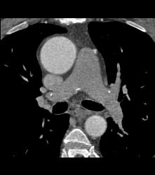 Aortic Valve Repair With Broken Stent in the Pulmonary Artery - CTisus CT Scan