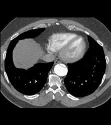 Type B Dissection Into the Abdominal Aorta - CTisus CT Scan