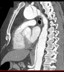 Type B Dissection Into the Abdominal Aorta - CTisus CT Scan