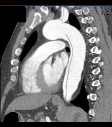 Type B Dissection Into the Abdominal Aorta - CTisus CT Scan