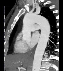 Type B Dissection Into the Abdominal Aorta - CTisus CT Scan