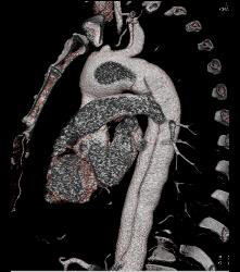 Type B Dissection Into the Abdominal Aorta - CTisus CT Scan