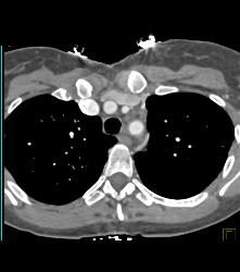 Mediastinal Nodes - CTisus CT Scan