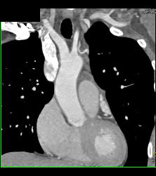 Prominent Atrial Appendage - CTisus CT Scan