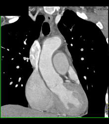 Prominent Atrial Appendage - CTisus CT Scan