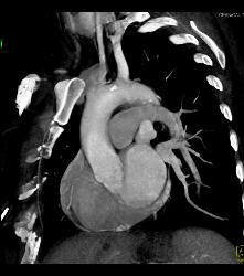 Prominent Atrial Appendage - CTisus CT Scan