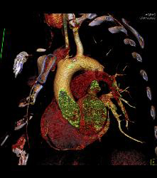 Prominent Atrial Appendage - CTisus CT Scan