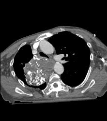 Germ Cell Tumor - CTisus CT Scan