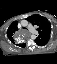 Germ Cell Tumor - CTisus CT Scan