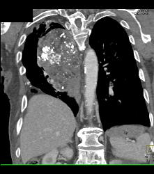 Germ Cell Tumor - CTisus CT Scan