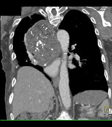 Germ Cell Tumor - CTisus CT Scan