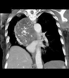 Germ Cell Tumor - CTisus CT Scan