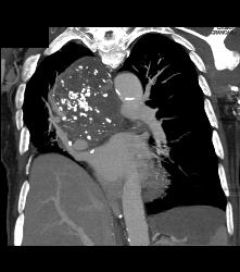 Germ Cell Tumor - CTisus CT Scan