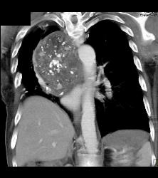 Germ Cell Tumor - CTisus CT Scan