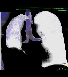 Germ Cell Tumor - CTisus CT Scan