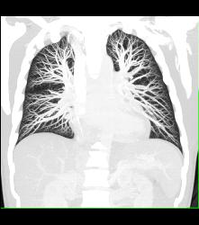 Normal Pulmonary Vasculature - CTisus CT Scan