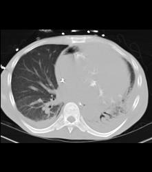 Air in Right Heart Due to Air in Line - CTisus CT Scan