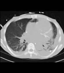 Air in Right Heart Due to Air in Line - CTisus CT Scan