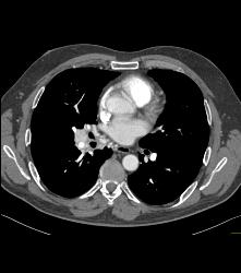 Paraganglioma Right Hilum With Dilated Bronchial Arteries - CTisus CT Scan