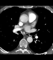 Paraganglioma Right Hilum With Dilated Bronchial Arteries - CTisus CT Scan