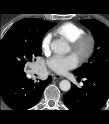 Paraganglioma Right Hilum With Dilated Bronchial Arteries - CTisus CT Scan