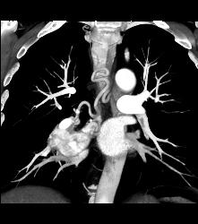 Paraganglioma Right Hilum With Dilated Bronchial Arteries - CTisus CT Scan