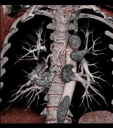 Paraganglioma Right Hilum With Dilated Bronchial Arteries - CTisus CT Scan