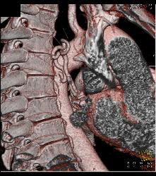 Paraganglioma Right Hilum With Dilated Bronchial Arteries - CTisus CT Scan