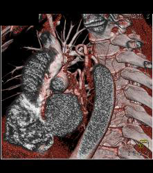 Paraganglioma Right Hilum With Dilated Bronchial Arteries - CTisus CT Scan