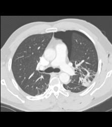 Pulmonary Contusion and Pneumothorax - CTisus CT Scan