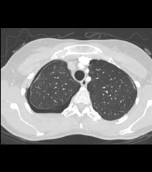 Bilateral Pneumothorax - CTisus CT Scan