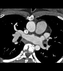 Dilated Arch With Stents in SVC and Pulmonary Arteries - CTisus CT Scan