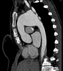 Dilated Arch With Stents in SVC and Pulmonary Arteries - CTisus CT Scan