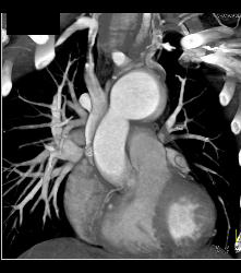 Dilated Arch With Stents in SVC and Pulmonary Arteries - CTisus CT Scan