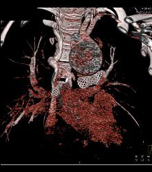 Dilated Arch With Stents in SVC and Pulmonary Arteries - CTisus CT Scan