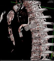 History of Coarctation of the Aorta (COA) With Repair and Stents in Pulmonary Arteries - CTisus CT Scan