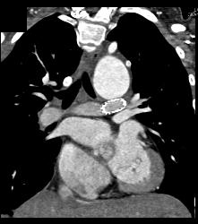 History of Coarctation of the Aorta (COA) With Repair and Stents in Pulmonary Arteries - CTisus CT Scan