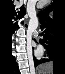 History of Coarctation of the Aorta (COA) With Repair and Stents in Pulmonary Arteries - CTisus CT Scan