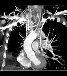 SVC Occlusion With Collaterals - CTisus CT Scan