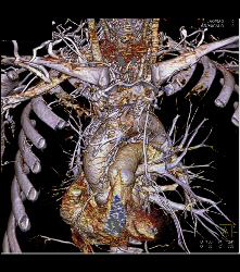 SVC Occlusion With Collaterals - CTisus CT Scan