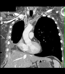 SVC Occlusion With Collaterals - CTisus CT Scan