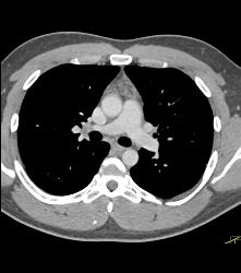 Thymic Hyperplasia - CTisus CT Scan