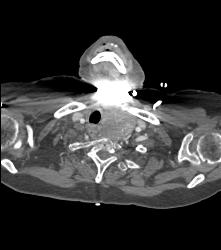 Substernal Thyroid - CTisus CT Scan