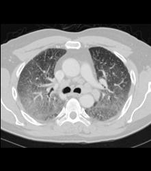 Pulmonary Edema and Failure- and Nodes - CTisus CT Scan